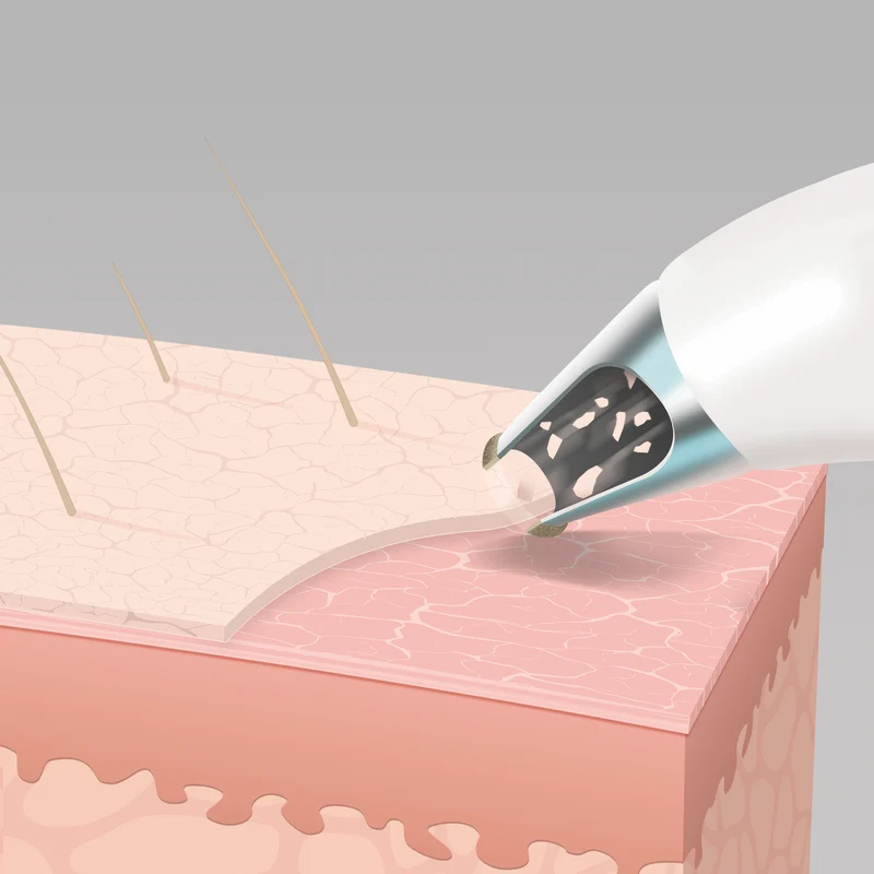 Homedics Radiance Microdermabrasion with Cooling